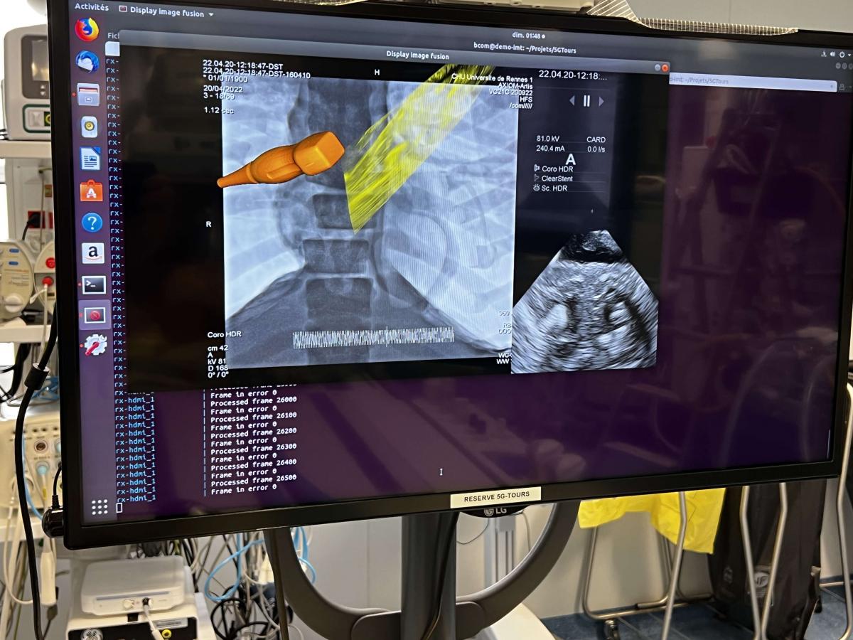 Les signaux de l’ultrason et du X-ray sont fusionnés par l'application de réalité augmentée et transmis par le réseau 5G 
